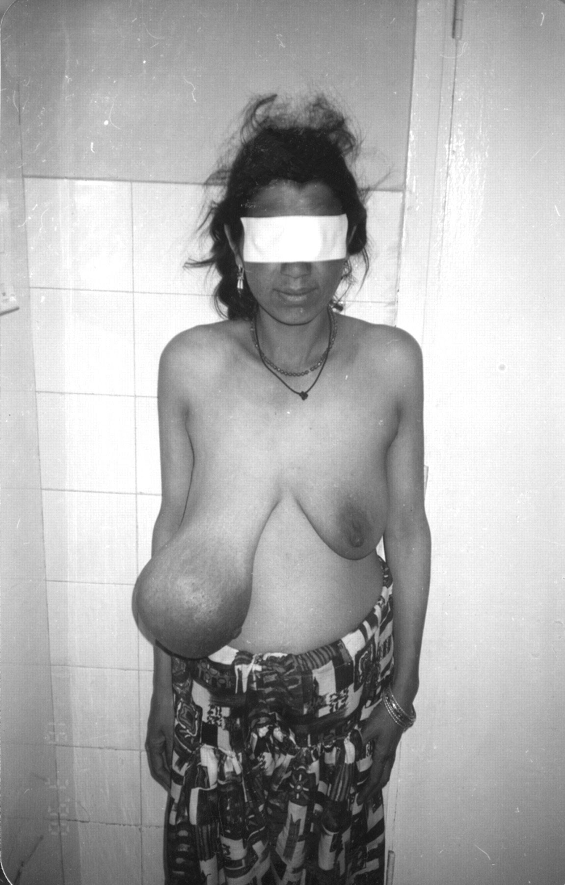 женщины с ампутированными грудями фото фото 62